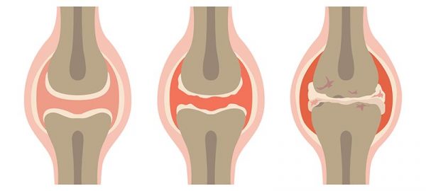 Príznaky osteoartrózy
